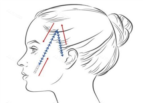 下颚缘面部埋线卡通示意图 下颚缘面部埋线卡通示意图