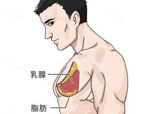 变性手术胸部结果示意图
