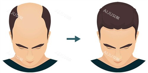 植发前后对比图 植发前后对比图