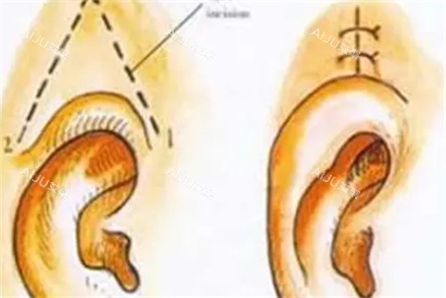 耳基底填充 耳基底填充