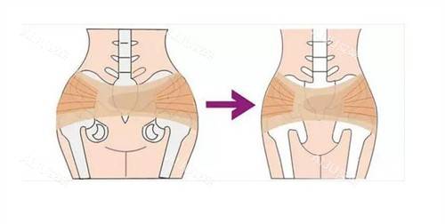 阴道紧缩手术盆骨前后对比图 阴道紧缩手术盆骨前后对比图