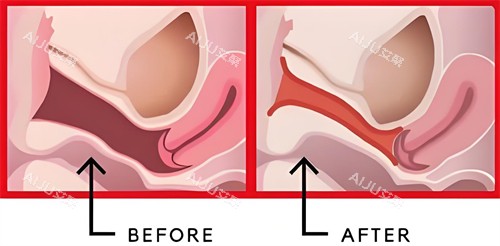 阴道紧缩手术前后对比动画图 阴道紧缩手术前后对比动画图