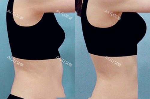 腰腹部吸脂手术前后对比图