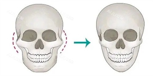 颧骨内推手术 颧骨内推手术