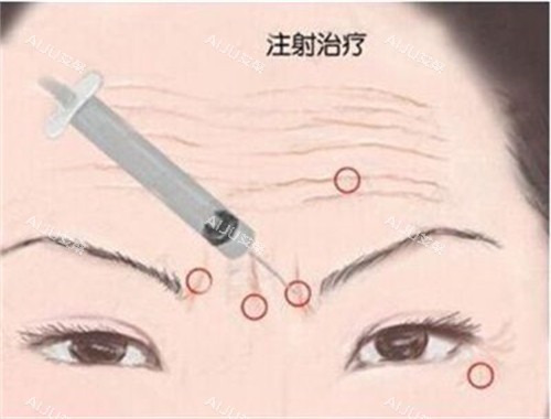 珀利肤宝宝针面部除皱注射法演示动画图图