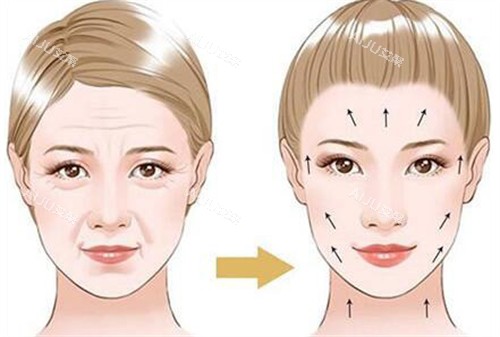 珀利肤宝宝针面部除皱术前术后对比演示动画图