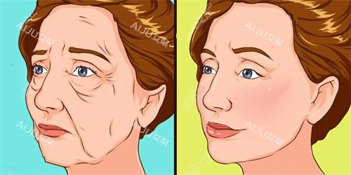 珀利肤宝宝针面部除皱前后对比演示动画图