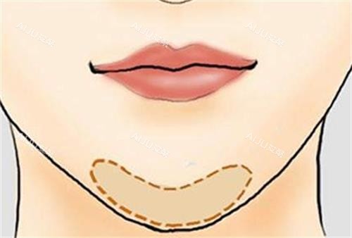医佳妍玻尿酸丰下巴的位置
