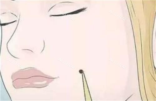 脸上有痣的示意图 脸上有痣的示意图
