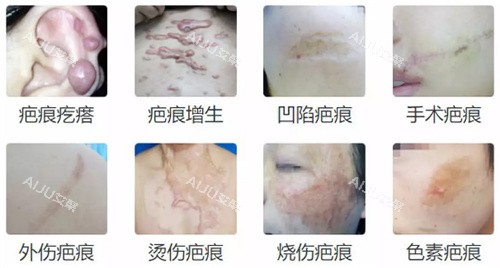 不同疤痕的类型 不同疤痕的类型