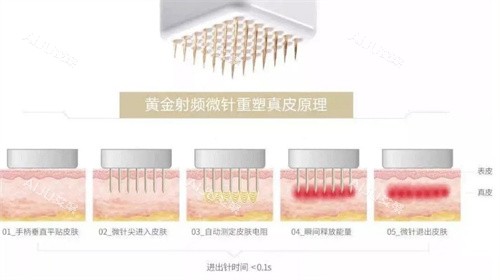 黄金微针原理 黄金微针原理
