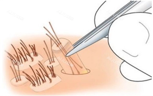 提取毛囊示意图 提取毛囊示意图