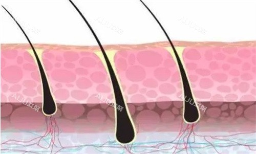 植发的毛囊 植发的毛囊
