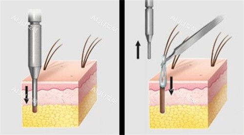 提取毛囊动画演示图图 提取毛囊动画演示图图