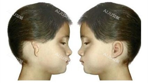 耳再造手术前后对比动画演示图 耳再造手术前后对比动画演示图