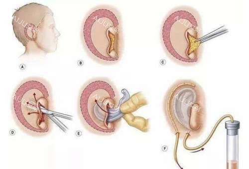 耳再造手术演示动画图 耳再造手术演示动画图