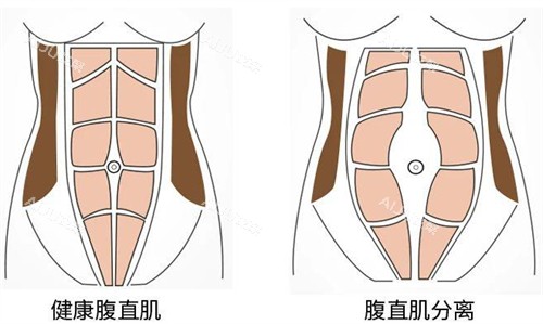 崔鑫医生腹壁成形术前后腹直肌的变化图解
