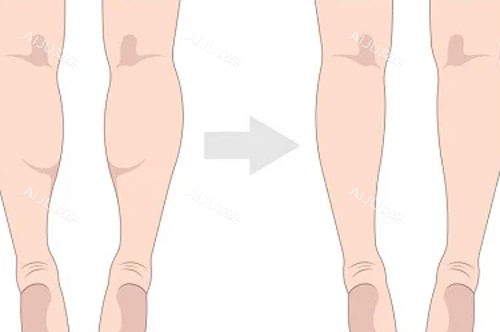 吸脂瘦小腿