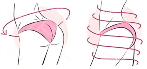 提臀手术呈现图