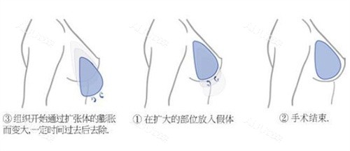 隆胸手术过程 隆胸手术过程