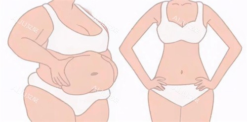 激光溶脂瘦腰腹对比图 激光溶脂瘦腰腹对比图