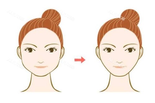 皮层光焊调整大小脸对比示意图