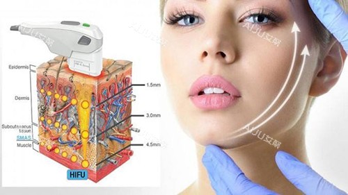 热玛吉 通用图 热玛吉 通用图