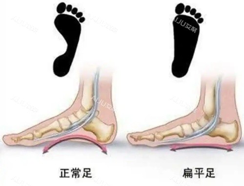 足弓塌陷漫画示意图