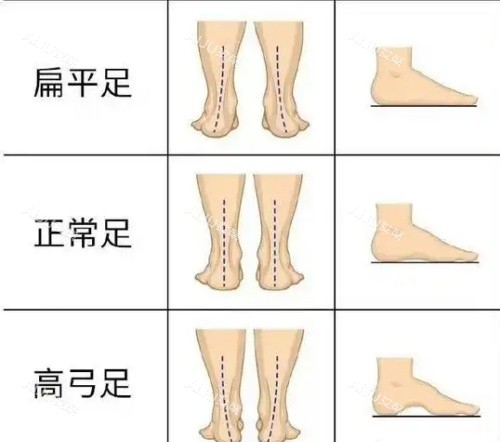 足弓塌陷程度示意图