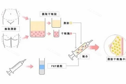 脂肪隆胸示意图3