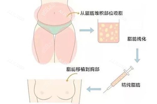脂肪隆胸示意图2