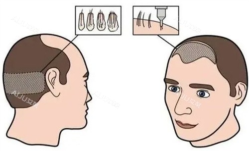 上海秃顶植发大概多少钱?公开上海做秃顶植发的价格,附三家人气植发医院名单 上海秃顶植发大概多少钱?公开上海做秃顶植发的价格,附三家人气植发医院名单