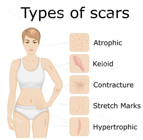 疤痕疙瘩4 疤痕疙瘩4