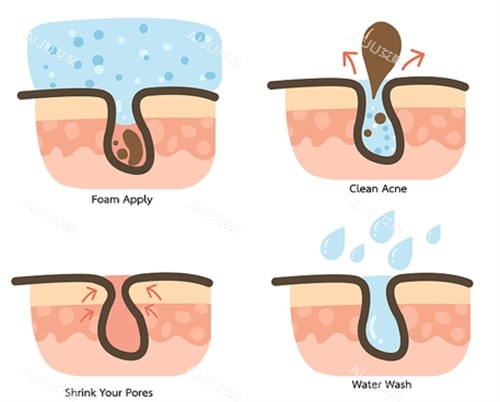 不同的毛孔问题 不同的毛孔问题