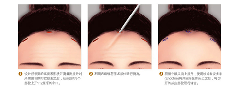 内视镜提眉手术动画演示图 内视镜提眉手术动画演示图