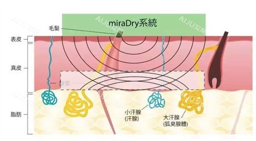 清新微波治疗狐臭原理