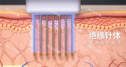 黄金微针针头图解