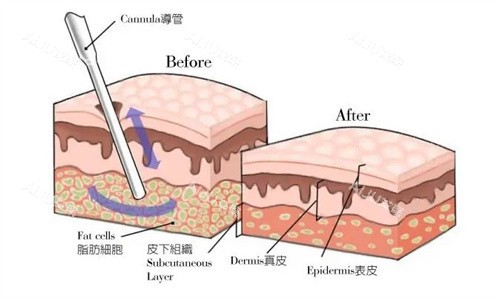 吸脂手术
