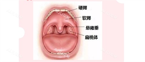 唇腭裂示意图