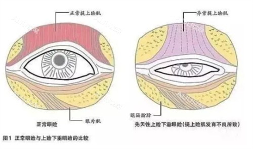 眼睑闭合不全的样子