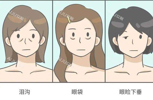 李喆眼周筋膜提升问题卡通示意图