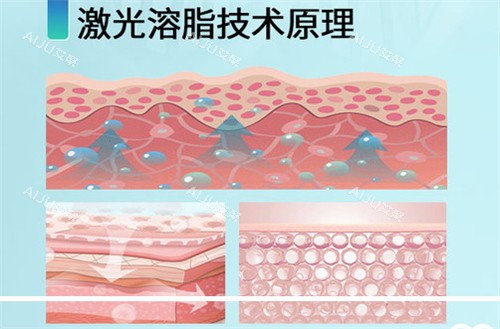 超声激光溶脂原理