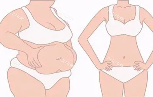德国Body-jet水动力全身吸脂前后对比示意图