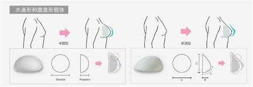 假体隆胸过程图 假体隆胸过程图