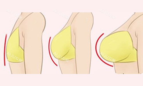 出彩医美十分钟隆胸要多少钱?7w~15w元不等,但术后可维持10年以上时间 出彩医美十分钟隆胸要多少钱?7w~15w元不等,但术后可维持10年以上时间