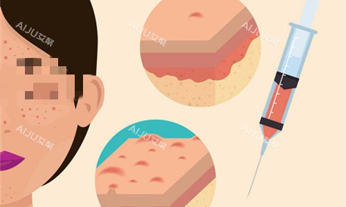 面部改善注射图 面部改善注射图