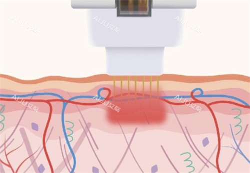 黄金微针施术过程图解