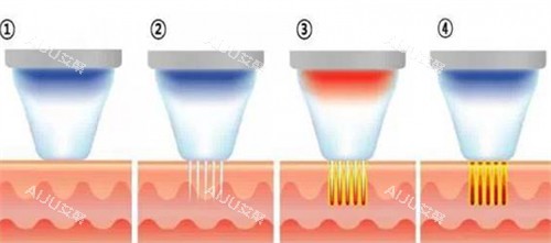 黄金微针施术步骤介绍