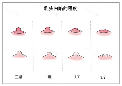 乳头内陷的程度演示图