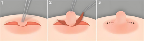 乳头内陷手术切口